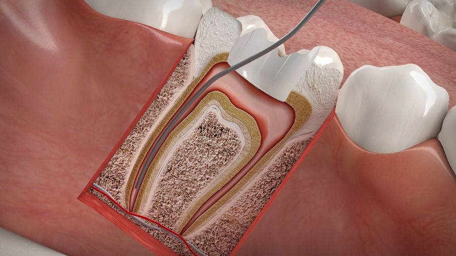 Wurzelkanalbehandlung