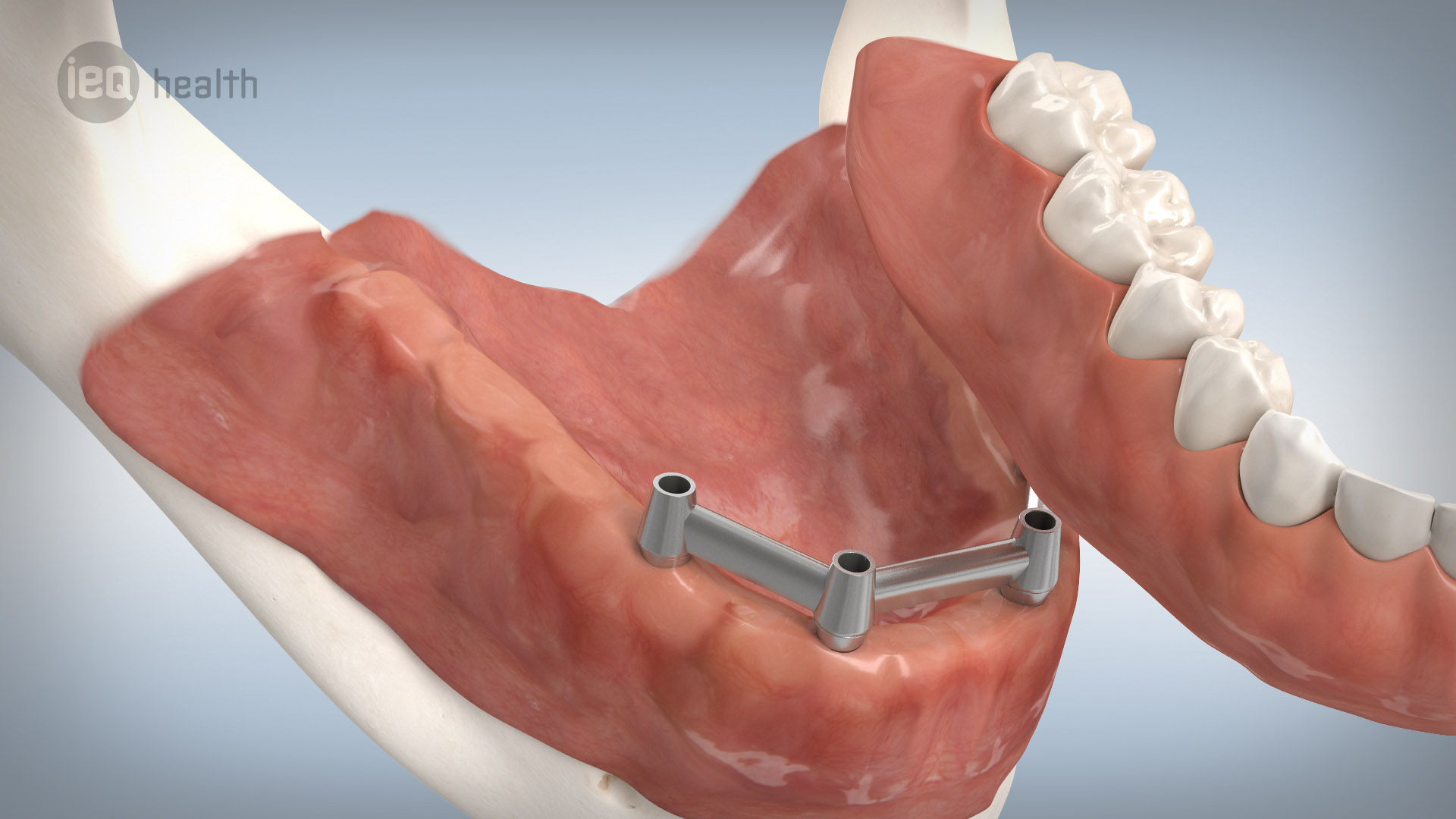 Zahnimplantate Fur Nurnberg Sud Fester Biss Und Hohe Asthetik